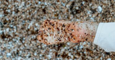 brown and white stone fragments on a person s bare foot